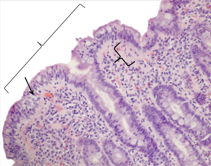 Coexisting Collagenous Sprue and Celiac Disease: A Case Report.