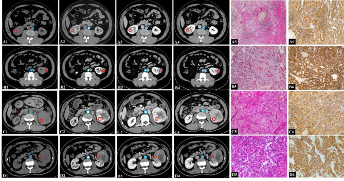 Predictive value of extracellular volume fraction determined using enhanced computed tomography for pathological grading of clear cell renal cell carcinoma: a preliminary study.