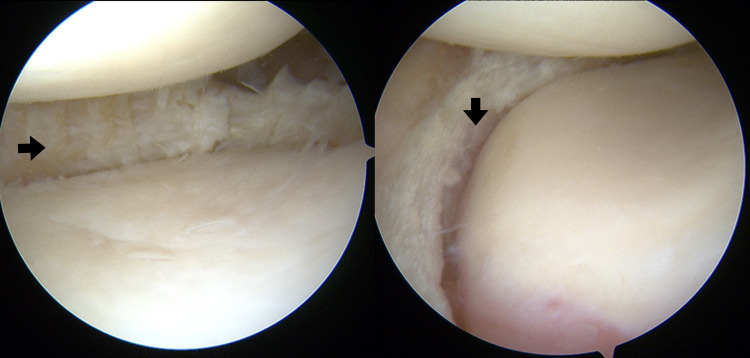 Report on Evolving Indications, Technique, and Outcomes of Novel And Surgical Procedures-NUsurface.