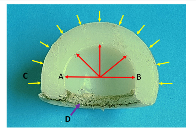 Dual Mobility Acetabular Cup Utilization in Total Hip Arthroplasty: Mitigating Instability Risks.