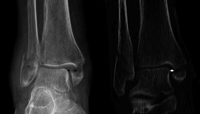 The medial clearspace is a risk factor for secondary dislocation following cast immobilization after closed reduction in closed ankle fracture dislocations.