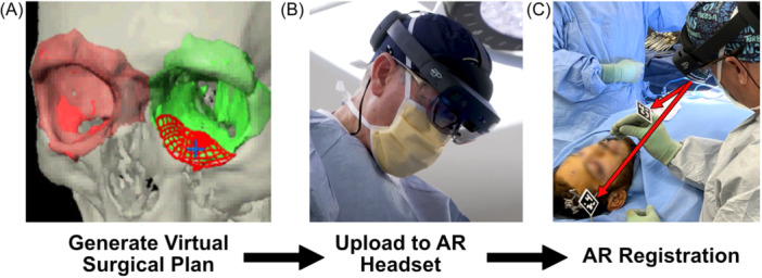 Augmented Reality Navigation in Craniomaxillofacial/Head and Neck Surgery.