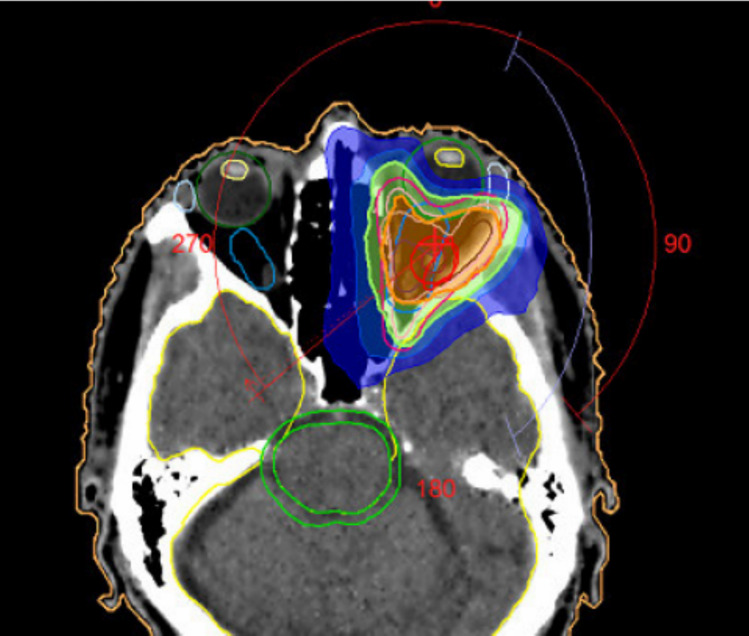 Durable response to nivolumab in combination with regional hyperthermia in a patient with PD-L1-negative metastatic head and neck squamous cell carcinoma.