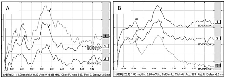 Intraoperative Assessment of Cochlear Nerve Function During Cochlear Implantation Using the Auditory Nerve Test Stimulator.