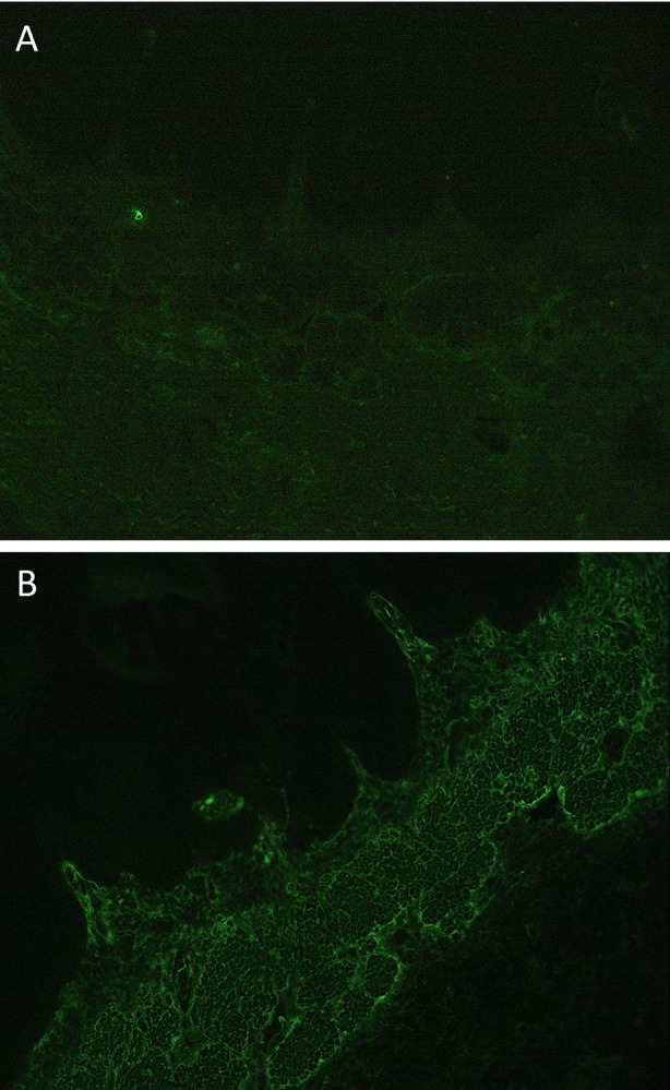 Prevalence and Significance of the Presence of Anti-transglutaminase and Anti-endomysium Antibodies in Patients with Early Inflammatory Joint Disease.