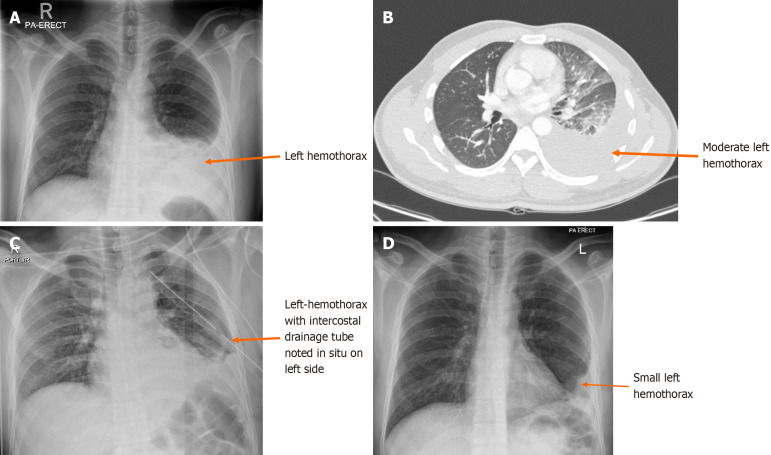 Time to resolution of radiologically detected hemothorax in trauma patients: A retrospective observational study.