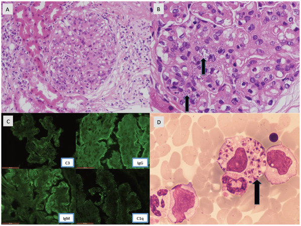 Anemia and lower limbs edemas in a patient with HIV infection.