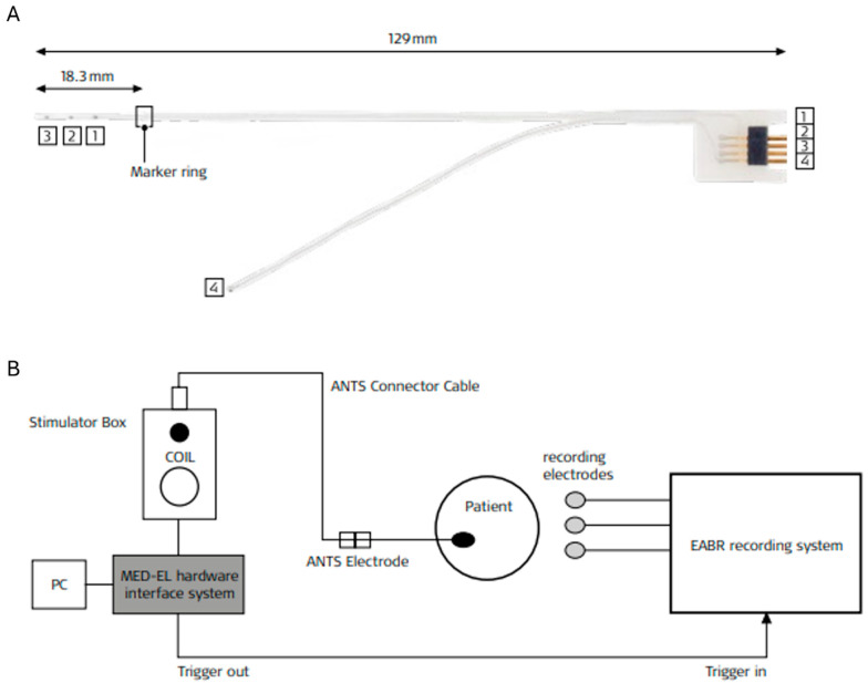 Intraoperative Assessment of Cochlear Nerve Function During Cochlear Implantation Using the Auditory Nerve Test Stimulator.