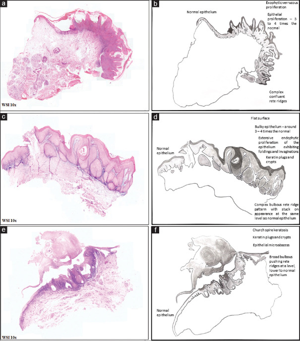 Barnaculate Carcinoma - A new terminology for the recognition of a histologically familiar entity.