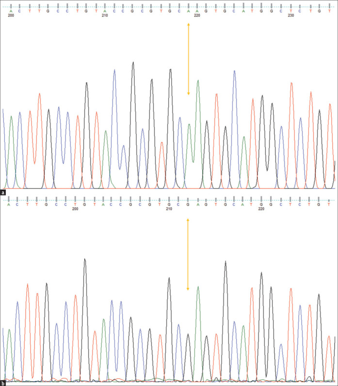 Novel SUN5 Mutation Associated with Acephalic Spermatozoa Syndrome: A Cross-sectional Study.