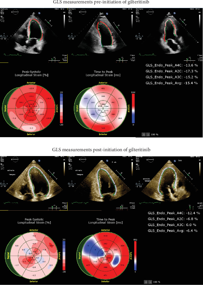 Heartbreak From Gilteritinib: Two Case Reports of Delayed Onset Cardiotoxicity.