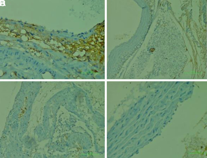 Protective Effect of Amifostine on Radiotherapy-Applied Cardiovascular Tissue.