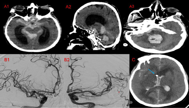 Acute Ischemic and Hemorrhagic Cerebrovascular Strokes After Cardiac Surgery: Incidence, Predictors, and Outcomes.
