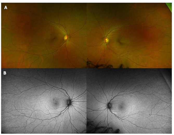 Bilateral acute multifocal retinitis and retinal vasculitis secondary to Rickettsia typhi infection.