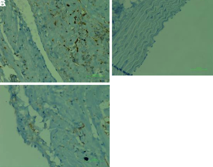 Protective Effect of Amifostine on Radiotherapy-Applied Cardiovascular Tissue.