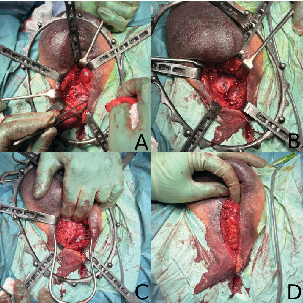 Perineal Incision for the Surgical Management of Extremely Proximal Internal Penile Fractures-A Case Series and Review of Literature.
