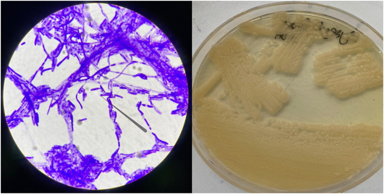 A Threat Emerging in Patients with Hematological Malignancy: Invasive Magnusiomyces capitatus and Magnusiomyces clavatus Infections.
