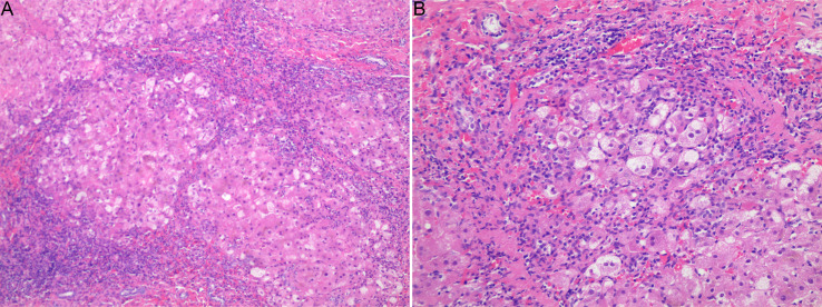Clinical Characteristics, Treatment Effects and Risk Factors of Liver Cirrhosis in Patients with Wilson's Disease Hepatic Type.
