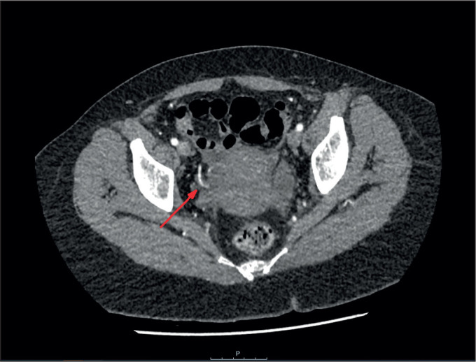 Spontaneous rupture of uterine artery in a non-pregnant woman with adenomyosis: a case report and review of current literature.