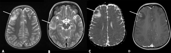 Safety and Diagnostic Utility of Brain Biopsy and Metagenomics in Decision-Making for Patients with Inborn Errors of Immunity (IEI) and Unexplained Neurological Manifestations.