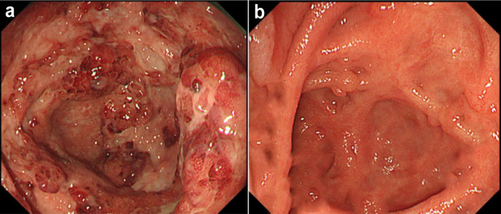 Intensive Granulocyte and Monocyte Adsorptive Apheresis Plus Upadacitinib for Induction Treatment of Refractory Crohn's Disease.