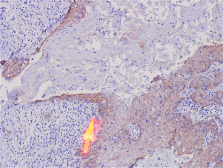Desmoglein 1 and 3 as potential markers of occult lymph node metastasis in oral cancer.