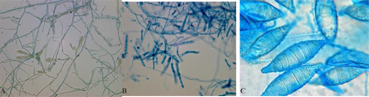 Onychomycosis among cancer patients undergoing chemotherapy in Tehran, Iran: a cross-sectional study.