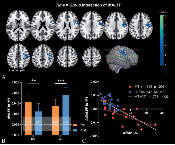Mirror therapy reduces excessive variability of motor network in stroke patients: a randomized controlled trial.