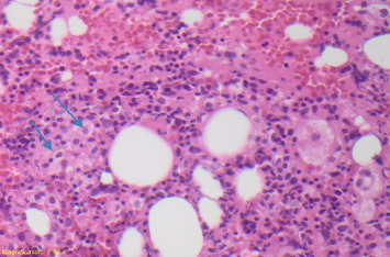 Febrile Pancytopenia and Hemophagocytosis From Disseminated Histoplasmosis in HIV/AIDS Patients: Two Cases and a Review of Combined Antifungal and Steroid Therapy.