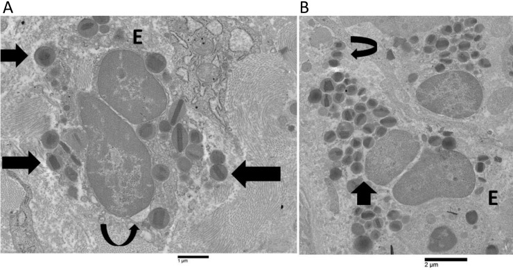 Eosinophil cytolysis with or without ETosis in four cases of human gastric cancer: a comparative ultrastructural study.