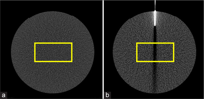 Usefulness of high tube voltage conditions in CT Fluoroscopy during CT-guided biopsy: Preliminary study.