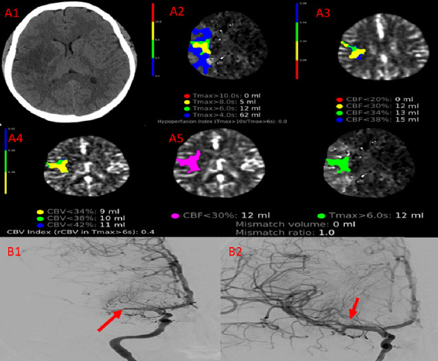Acute Ischemic and Hemorrhagic Cerebrovascular Strokes After Cardiac Surgery: Incidence, Predictors, and Outcomes.