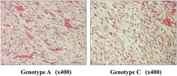 Association between Kaposi's sarcoma-associated herpesvirus genotype and clinical types.