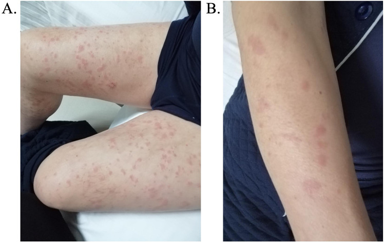 From Urticaria to Correct Diagnosis: A Case Report of Cryopyrin-Associated Periodic Syndromes.