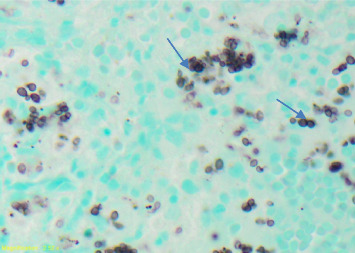 Febrile Pancytopenia and Hemophagocytosis From Disseminated Histoplasmosis in HIV/AIDS Patients: Two Cases and a Review of Combined Antifungal and Steroid Therapy.