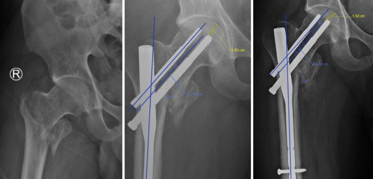 Medial cortical reduction does not influence outcomes in geriatric intertrochanteric femur fractures treated with proximal femoral nail.