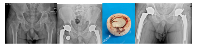 Dual Mobility Acetabular Cup Utilization in Total Hip Arthroplasty: Mitigating Instability Risks.