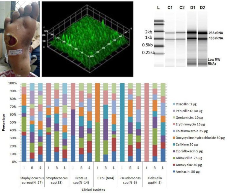 Insights into global transcriptomic profile of biofilm producing <i>Staphylococcus aureus</i> clinical isolates from chronic foot ulcers.