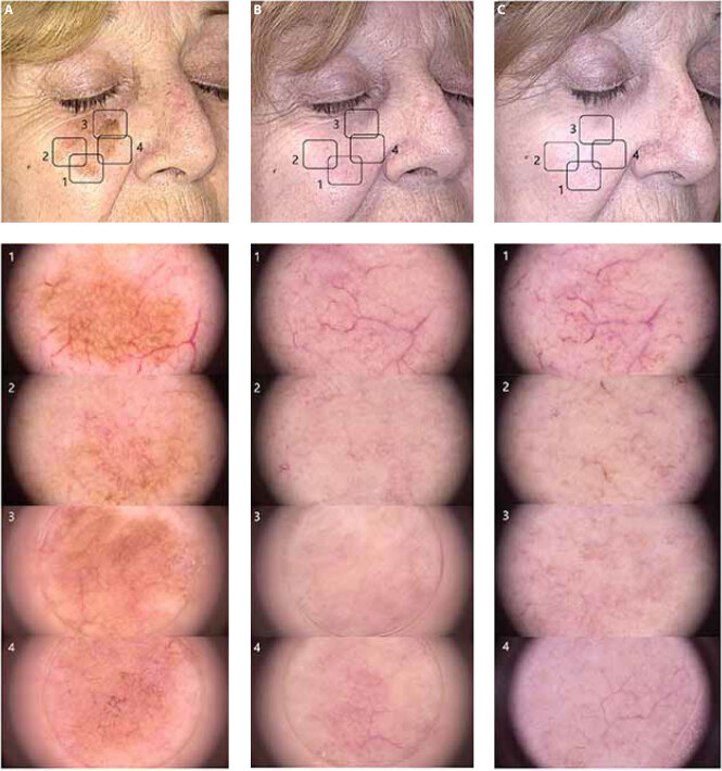 Long-Term Response to Imiquimod for the Treatment of Lentigo Maligna Assessed With Digital Dermoscopy.