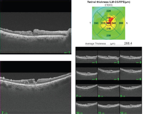 Baseline macular structural and vascular changes as predictive markers of visual improvement in central retinal vein occlusion.