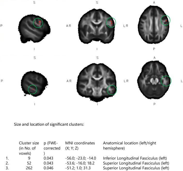 Effect of physical exercise on white matter microstructure in chemotherapy-treated breast cancer patients: a randomized controlled trial (PAM study).