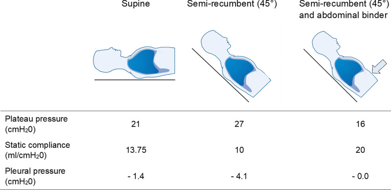 Invasive Pleural Manometry to Explore the Physiology Behind Paradoxical Compliance Response to Abdominal Compression-A Case of "Unexpandable" Lung in Acute Respiratory Distress Syndrome.