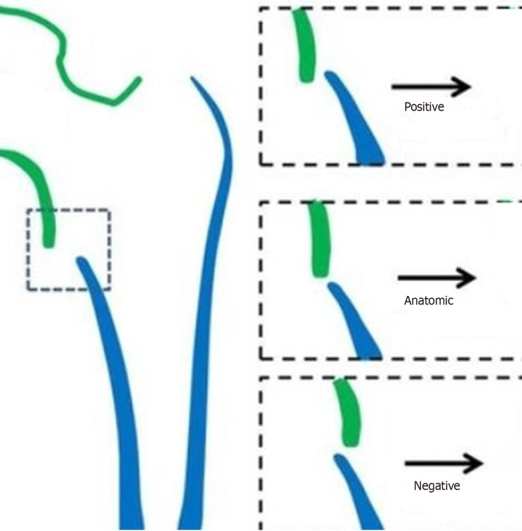 Medial cortical reduction does not influence outcomes in geriatric intertrochanteric femur fractures treated with proximal femoral nail.