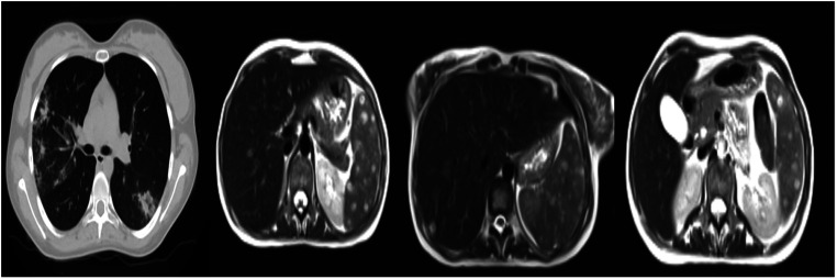 A Threat Emerging in Patients with Hematological Malignancy: Invasive Magnusiomyces capitatus and Magnusiomyces clavatus Infections.