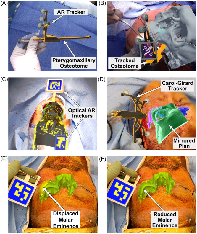 Augmented Reality Navigation in Craniomaxillofacial/Head and Neck Surgery.