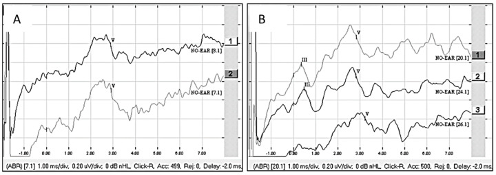 Intraoperative Assessment of Cochlear Nerve Function During Cochlear Implantation Using the Auditory Nerve Test Stimulator.