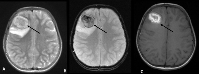 Safety and Diagnostic Utility of Brain Biopsy and Metagenomics in Decision-Making for Patients with Inborn Errors of Immunity (IEI) and Unexplained Neurological Manifestations.