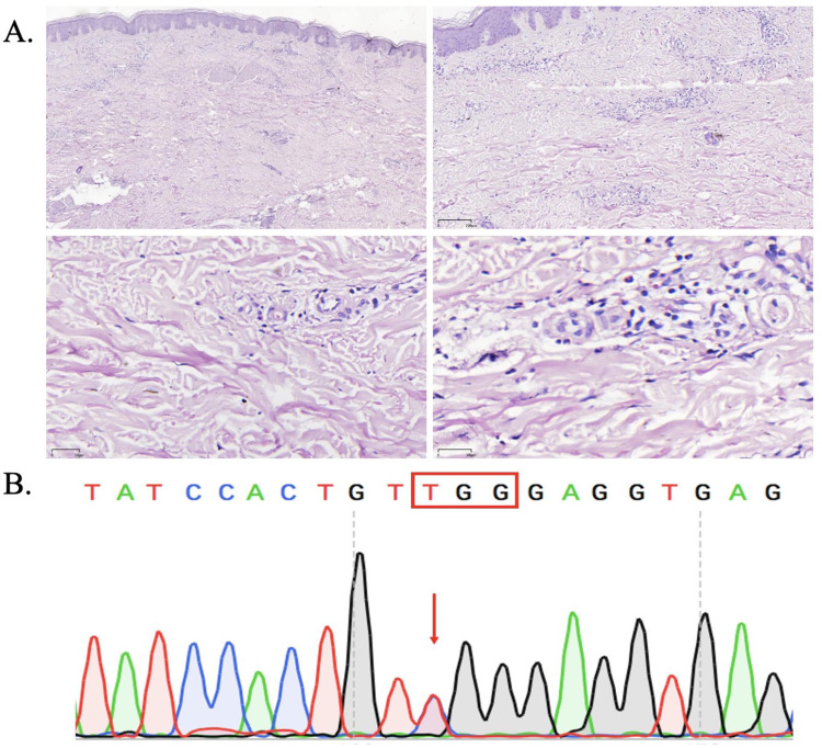 From Urticaria to Correct Diagnosis: A Case Report of Cryopyrin-Associated Periodic Syndromes.