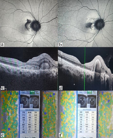 Evaluating short-term corneal endothelial alterations post-intravitreal Anti-VEGF injections in treatment naïve eyes.