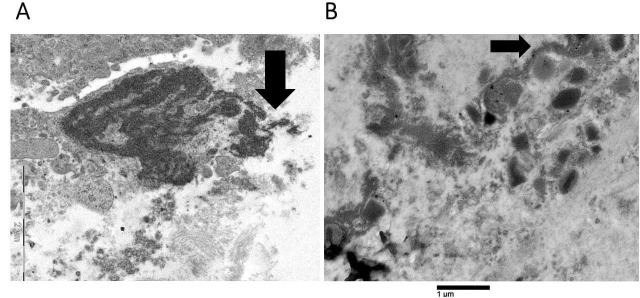 Eosinophil cytolysis with or without ETosis in four cases of human gastric cancer: a comparative ultrastructural study.